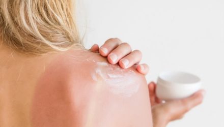 5 рекомендаций по уходу за кожей и предотвращению солнечных ожогов